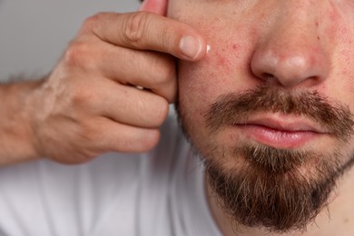 Photo of Young man with acne problem applying cream onto his face on light grey background, closeup