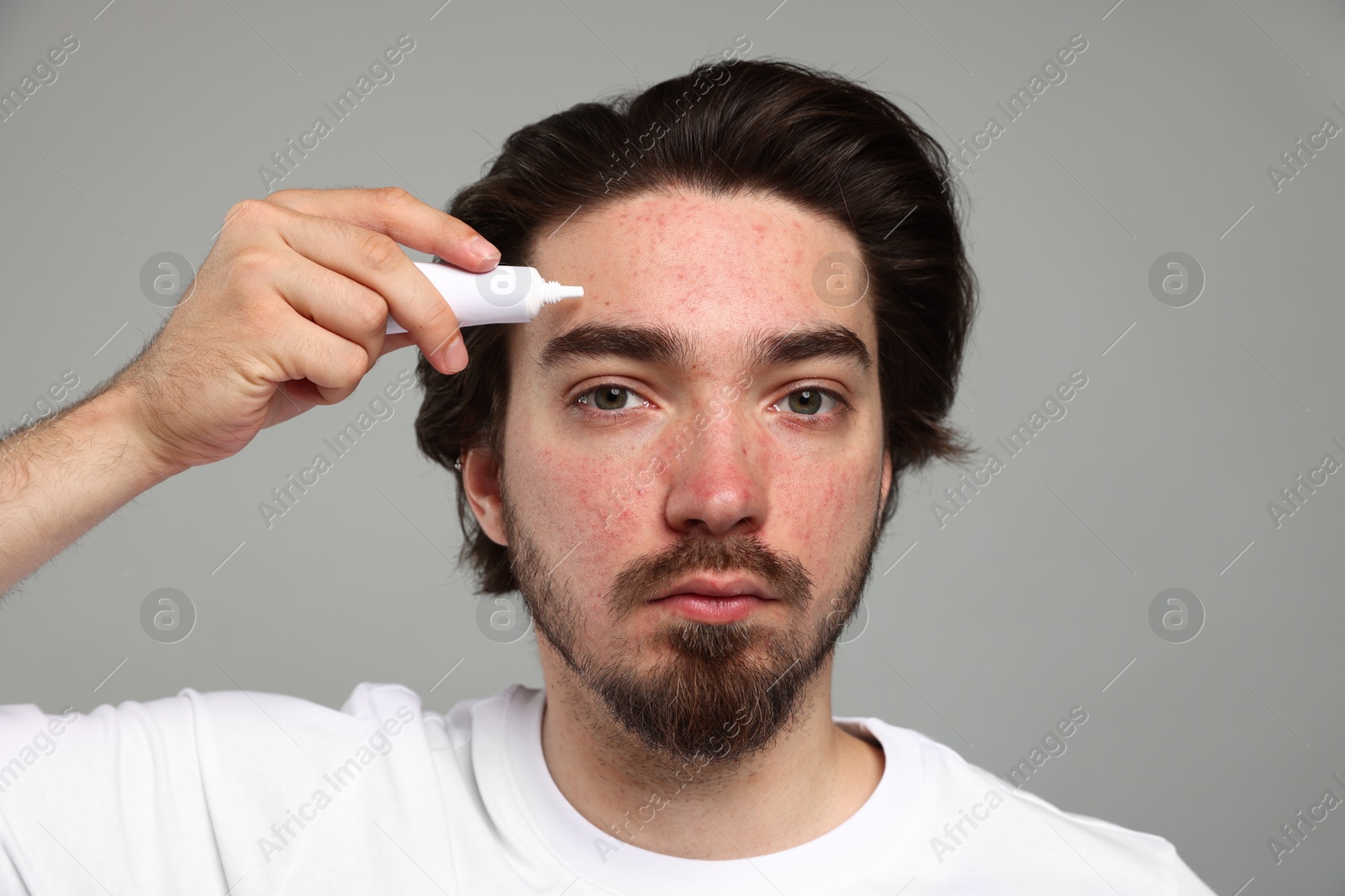 Young man with acne problem applying cream onto his face on light grey background Photo of Young man with acne problem applying cream onto his face on light grey background
