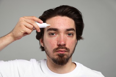 Photo of Young man with acne problem applying cream onto his face on light grey background