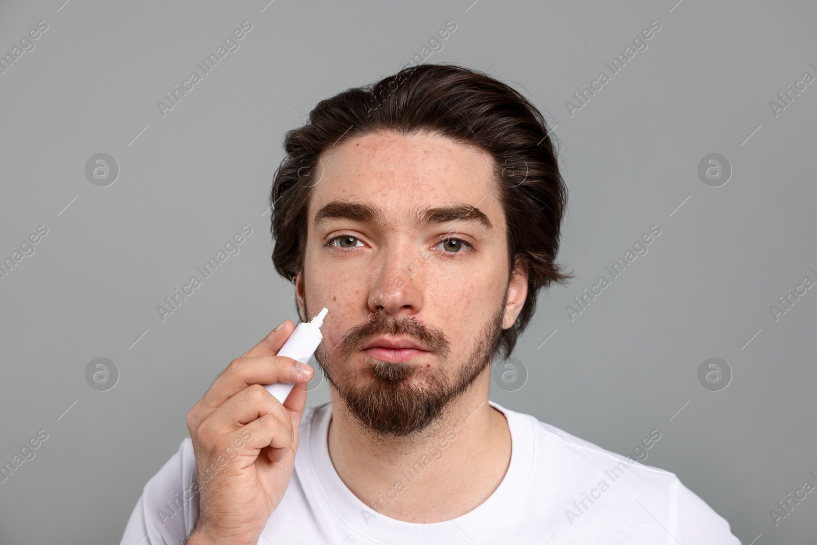 Young man with acne problem applying cream onto his face on light grey background Photo of Young man with acne problem applying cream onto his face on light grey background