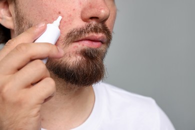 Photo of Young man with acne problem applying cream onto his face on light grey background, closeup