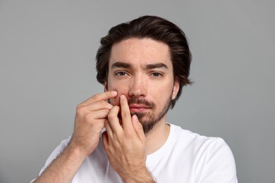 Photo of Young man with acne problem on light grey background