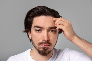 Photo of Young man with acne problem on light grey background