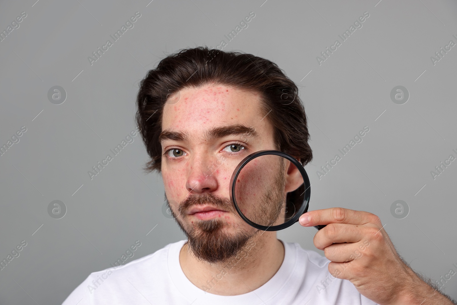 Young man with acne problem holding magnifying glass near his face on light grey background Photo of Young man with acne problem holding magnifying glass near his face on light grey background