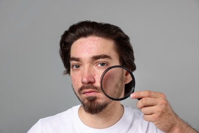 Photo of Young man with acne problem holding magnifying glass near his face on light grey background
