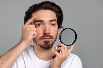 Photo of Young man with acne problem holding magnifying glass near his face on light grey background