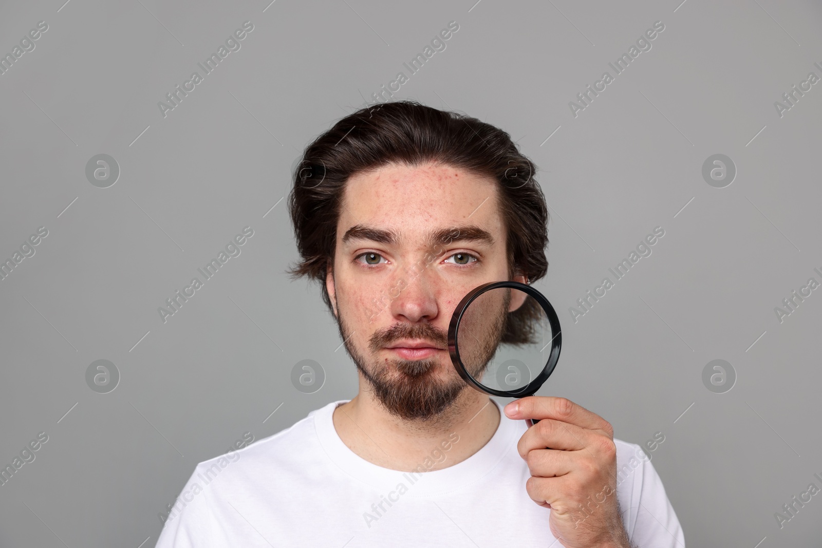 Young man with acne problem holding magnifying glass near his face on light grey background Photo of Young man with acne problem holding magnifying glass near his face on light grey background