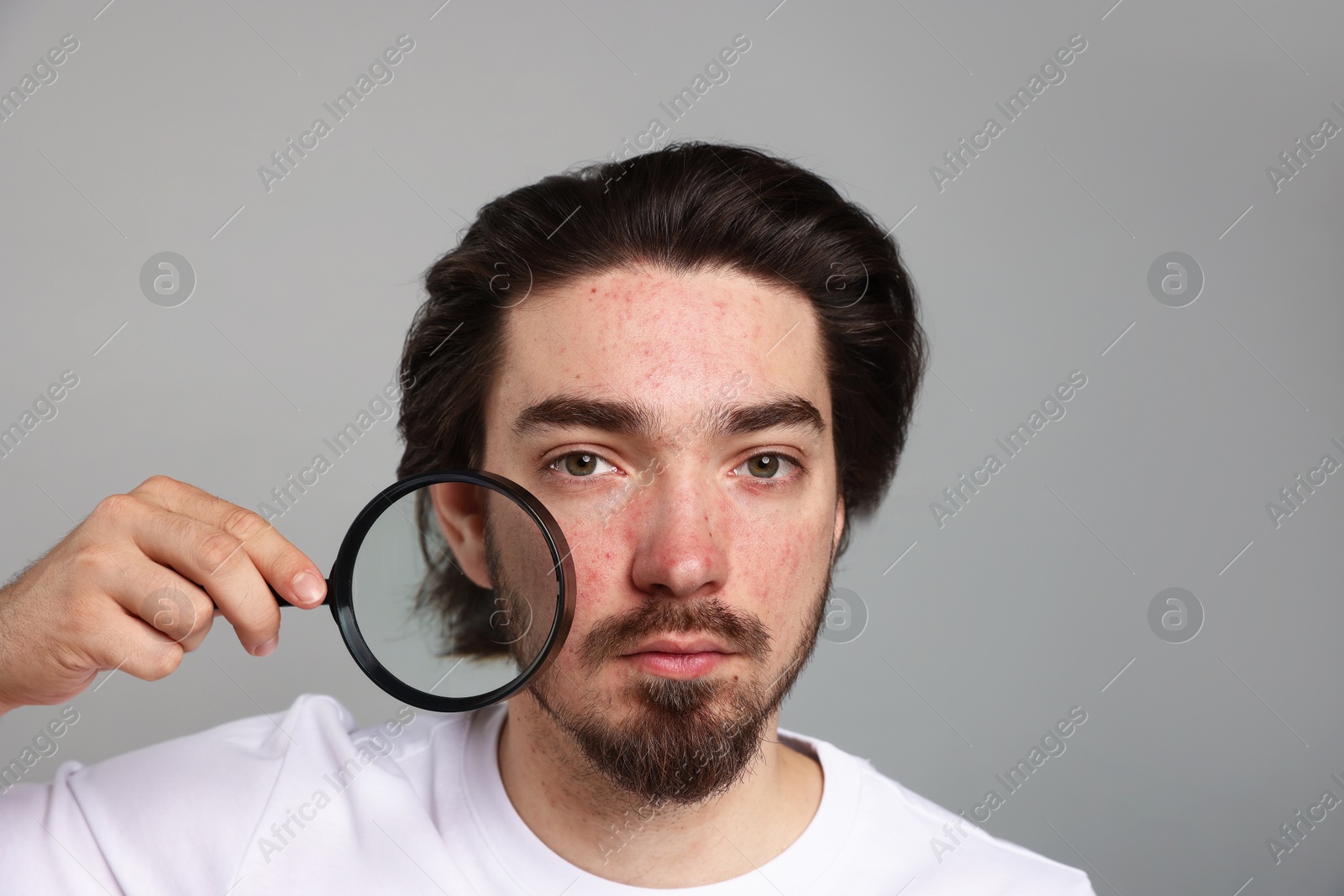 Young man with acne problem holding magnifying glass near his face on light grey background Photo of Young man with acne problem holding magnifying glass near his face on light grey background