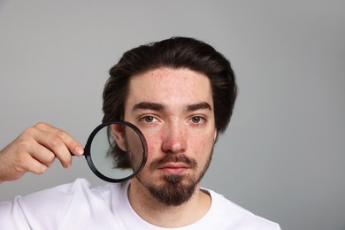 Photo of Young man with acne problem holding magnifying glass near his face on light grey background