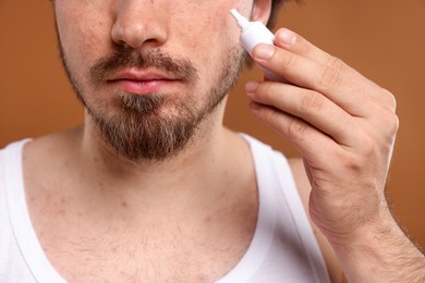 Photo of Young man with acne problem applying cream onto his face on brown background, closeup