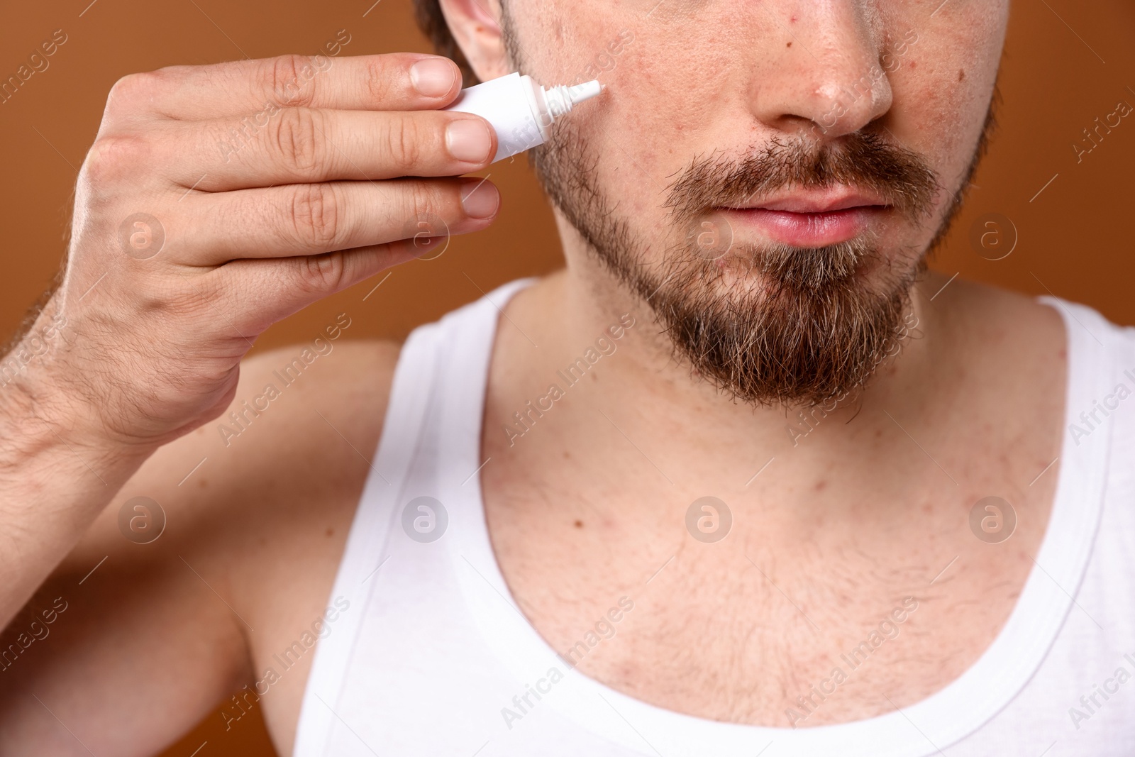 Young man with acne problem applying cream onto his face on brown background, closeup Photo of Young man with acne problem applying cream onto his face on brown background, closeup