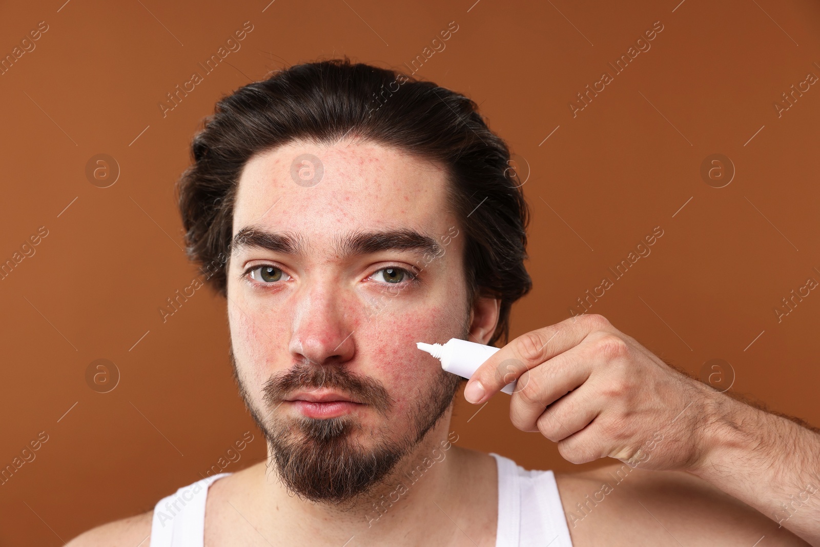Young man with acne problem applying cream onto his face on brown background Photo of Young man with acne problem applying cream onto his face on brown background