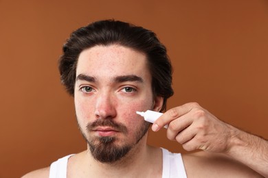 Photo of Young man with acne problem applying cream onto his face on brown background