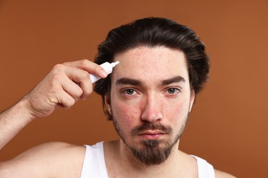 Photo of Young man with acne problem applying cream onto his face on brown background