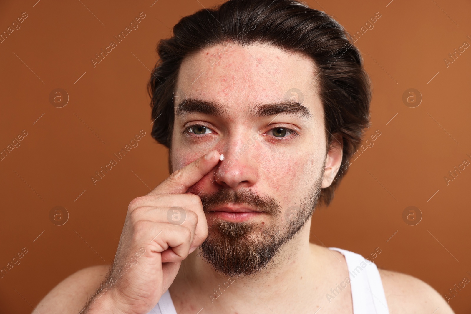 Young man with acne problem applying cream onto his face on brown background Photo of Young man with acne problem applying cream onto his face on brown background
