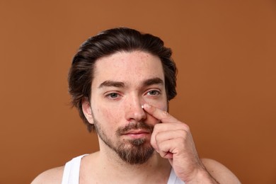 Photo of Young man with acne problem applying cream onto his face on brown background