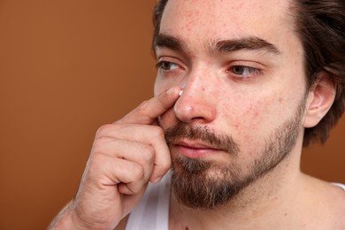 Photo of Young man with acne problem applying cream onto his face on brown background, closeup