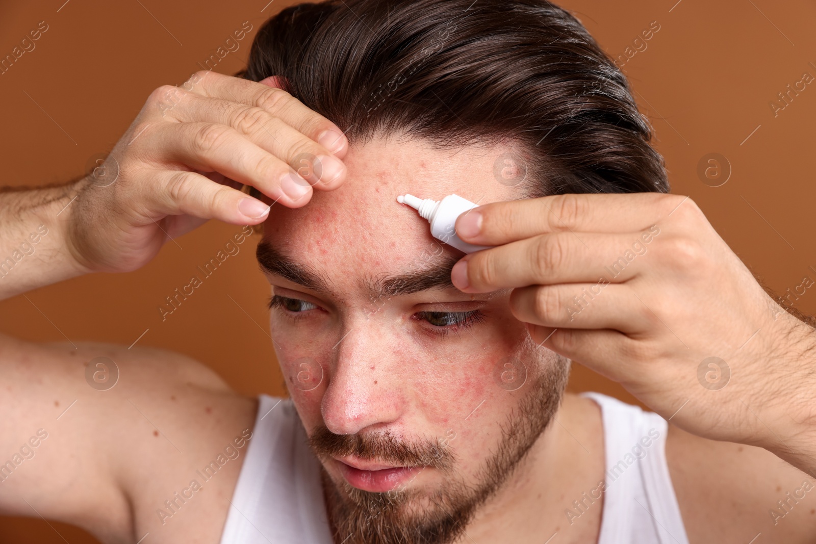Young man with acne problem applying cream onto his face on brown background, closeup Photo of Young man with acne problem applying cream onto his face on brown background, closeup