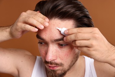 Photo of Young man with acne problem applying cream onto his face on brown background, closeup