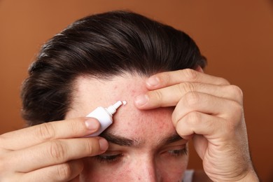 Photo of Young man with acne problem applying cream onto his face on brown background, closeup