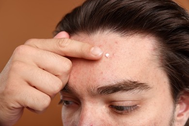 Photo of Young man with acne problem applying cream onto his face on brown background, closeup