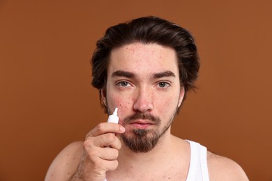 Photo of Young man with acne problem applying cream onto his face on brown background