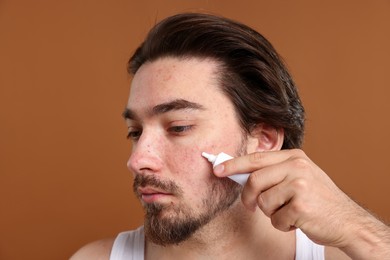 Photo of Young man with acne problem applying cream onto his face on brown background