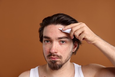 Photo of Young man with acne problem applying cream onto his face on brown background