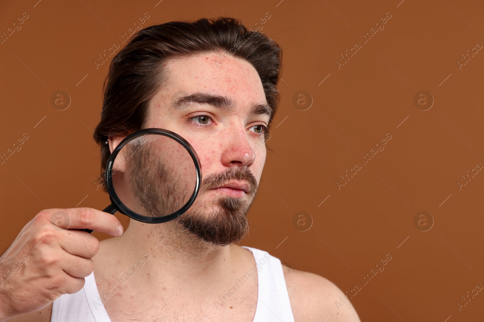 Young man with acne problem holding magnifying glass near his face on brown background. Space for text Photo of Young man with acne problem holding magnifying glass near his face on brown background. Space for text