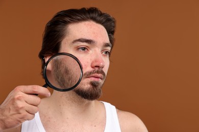 Photo of Young man with acne problem holding magnifying glass near his face on brown background. Space for text