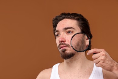 Photo of Young man with acne problem holding magnifying glass near his face on brown background. Space for text