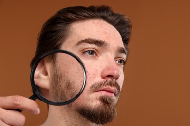 Photo of Young man with acne problem holding magnifying glass near his face on brown background, closeup