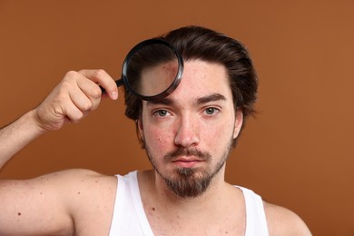 Photo of Young man with acne problem holding magnifying glass near his face on brown background