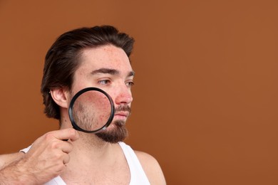 Photo of Young man with acne problem holding magnifying glass near his face on brown background. Space for text