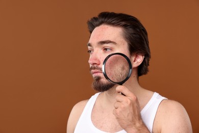 Photo of Young man with acne problem holding magnifying glass near his face on brown background. Space for text