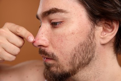 Photo of Young man with acne problem applying cream onto his face on brown background, closeup