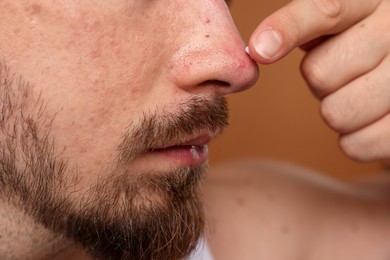 Photo of Young man with acne problem applying cream onto his face on brown background, closeup