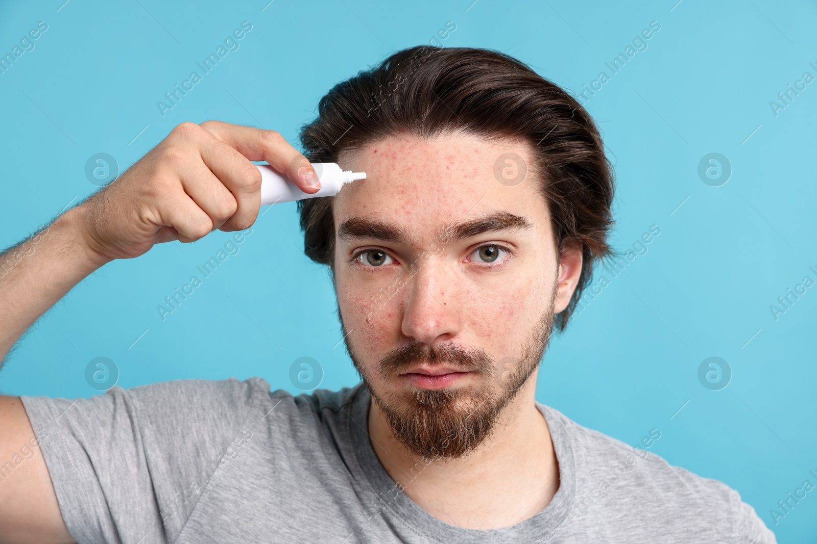 Young man with acne problem applying cream onto his face on light blue background Photo of Young man with acne problem applying cream onto his face on light blue background