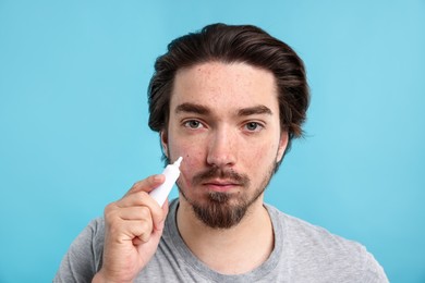 Photo of Young man with acne problem applying cream onto his face on light blue background