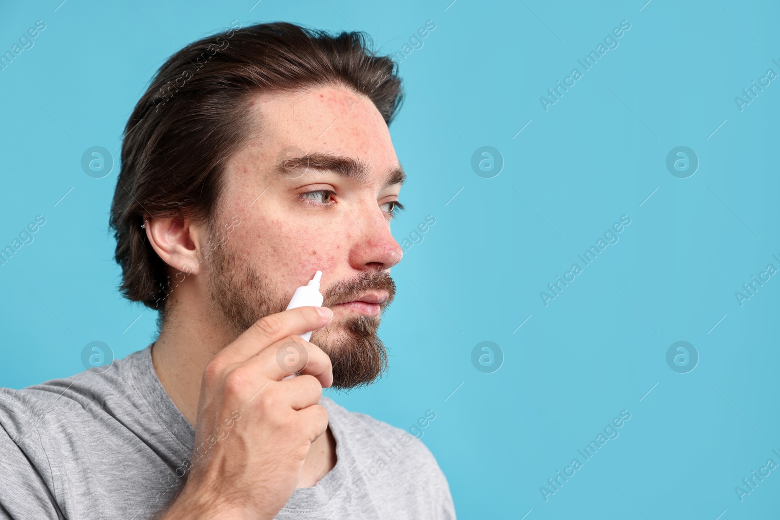 Young man with acne problem applying cream onto his face on light blue background, space for text Photo of Young man with acne problem applying cream onto his face on light blue background, space for text