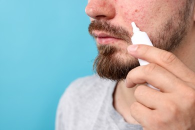 Photo of Young man with acne problem applying cream onto his face on light blue background, closeup. Space for text