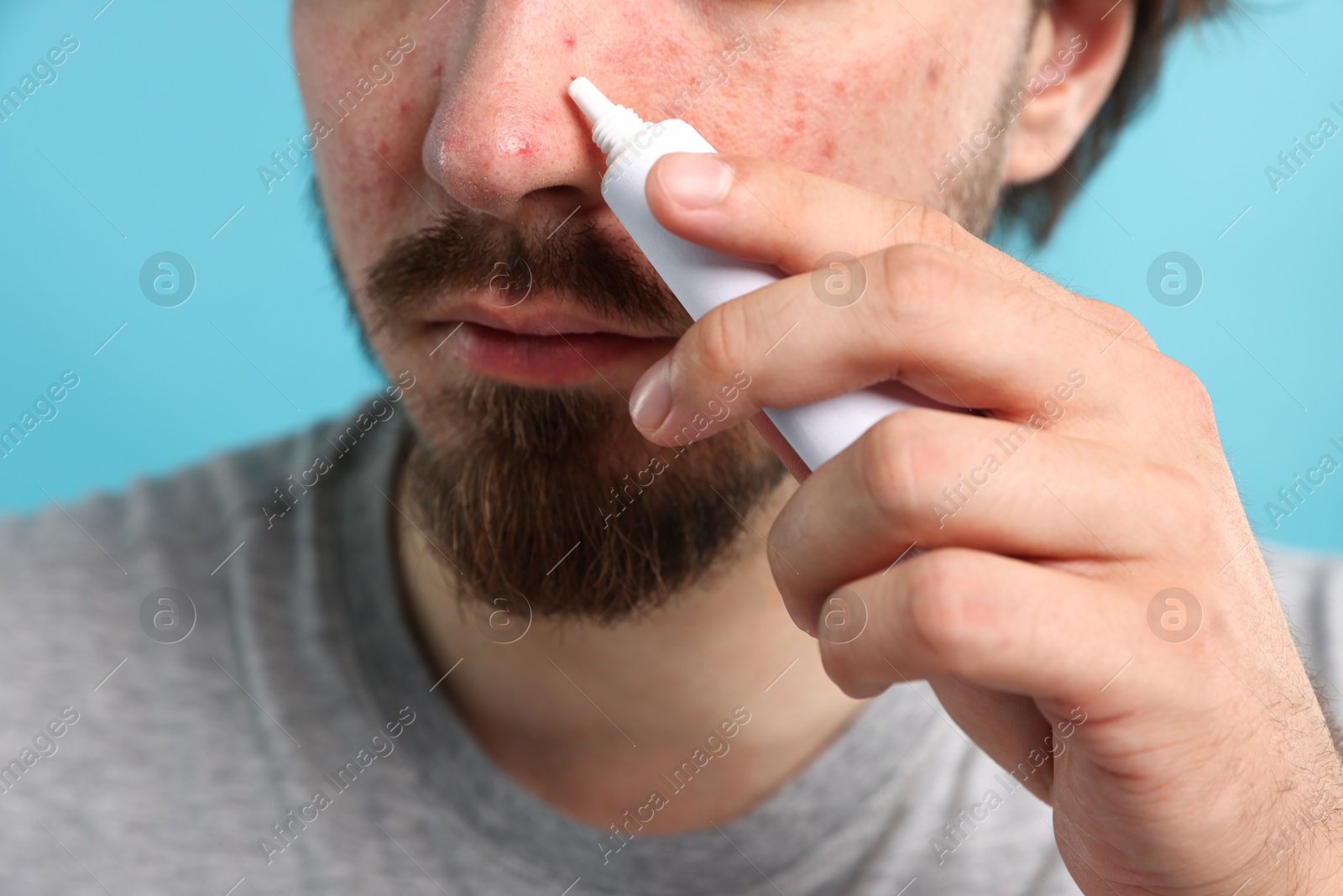 Young man with acne problem applying cream onto his face on light blue background, closeup Photo of Young man with acne problem applying cream onto his face on light blue background, closeup