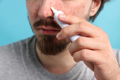 Photo of Young man with acne problem applying cream onto his face on light blue background, closeup