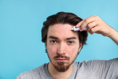 Photo of Young man with acne problem applying cream onto his face on light blue background