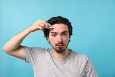 Photo of Young man with acne problem applying cream onto his face on light blue background