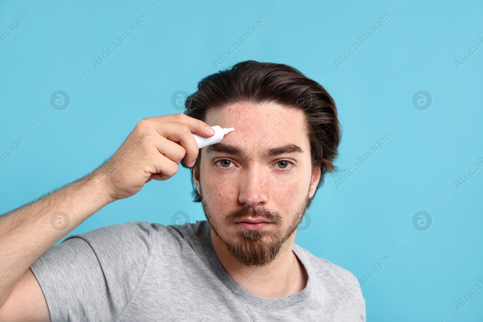 Young man with acne problem applying cream onto his face on light blue background Photo of Young man with acne problem applying cream onto his face on light blue background