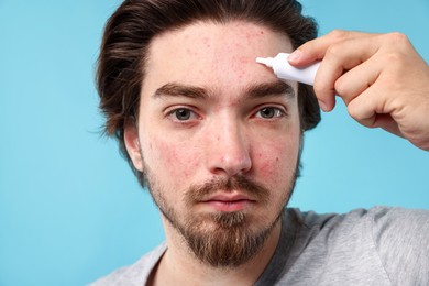 Photo of Young man with acne problem applying cream onto his face on light blue background, closeup