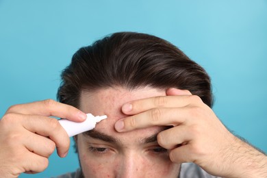 Photo of Young man with acne problem applying cream onto his face on light blue background, closeup