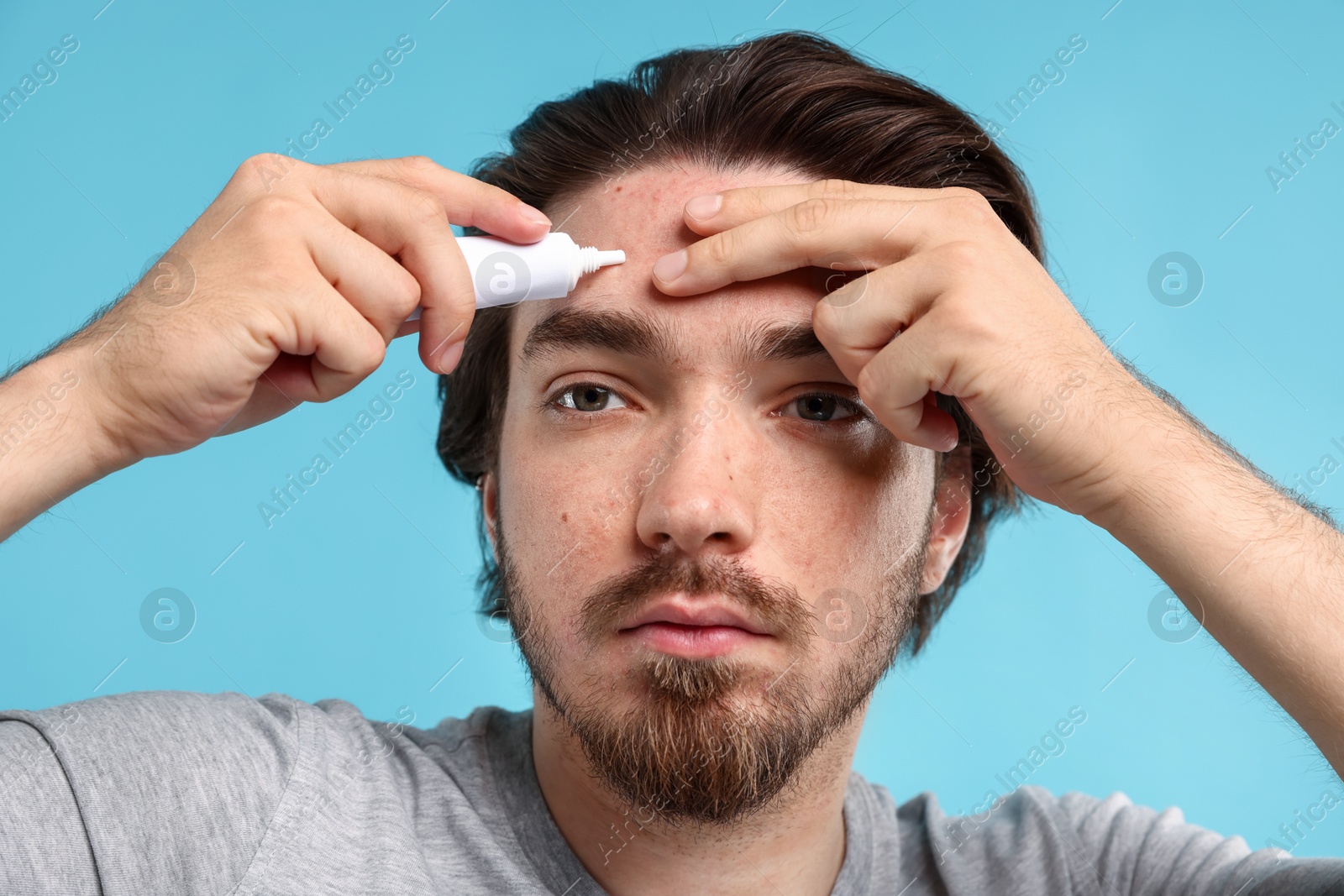 Young man with acne problem applying cream onto his face on light blue background, closeup Photo of Young man with acne problem applying cream onto his face on light blue background, closeup