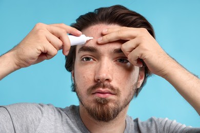 Photo of Young man with acne problem applying cream onto his face on light blue background, closeup